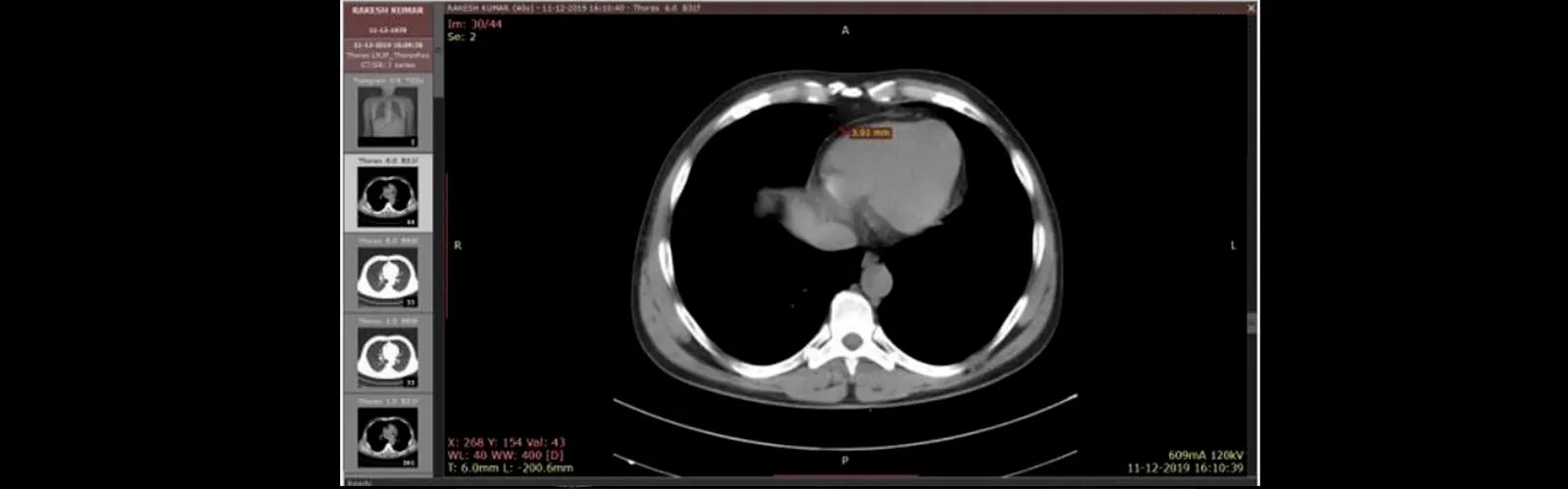 What is the Purpose of NCCT Chest Scan?